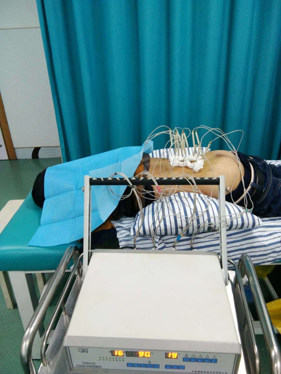 除肌骨疼痛之利器密集型银质针及针刀