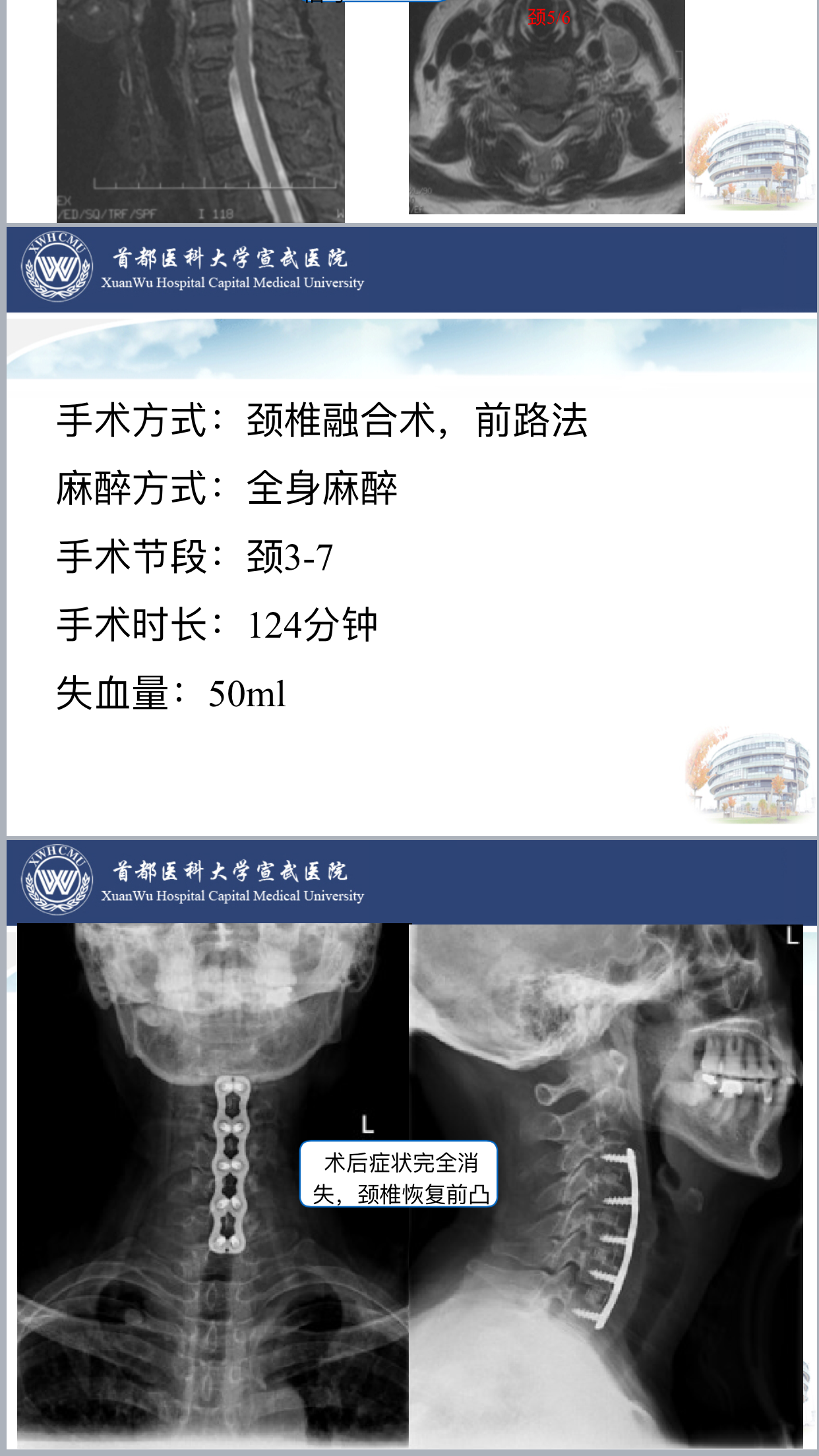 颈椎病合并后凸畸形的治疗 好大夫在线