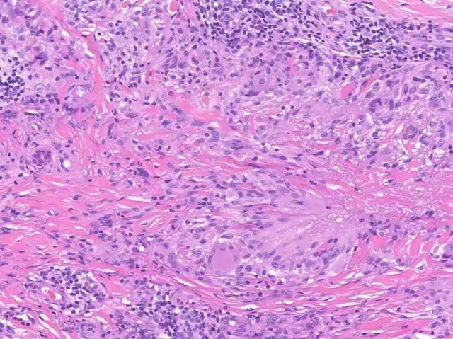 光线性肉芽肿actinicgranuloma