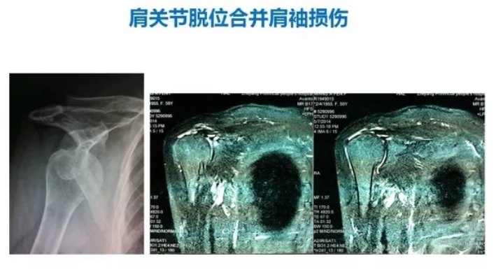 关节脱位肩关节前脱位的多种手法复位方法