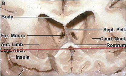 周围解剖结构的理解:1,尾状核头内侧与蝶骨嵴稍前部基本呈上下关系.
