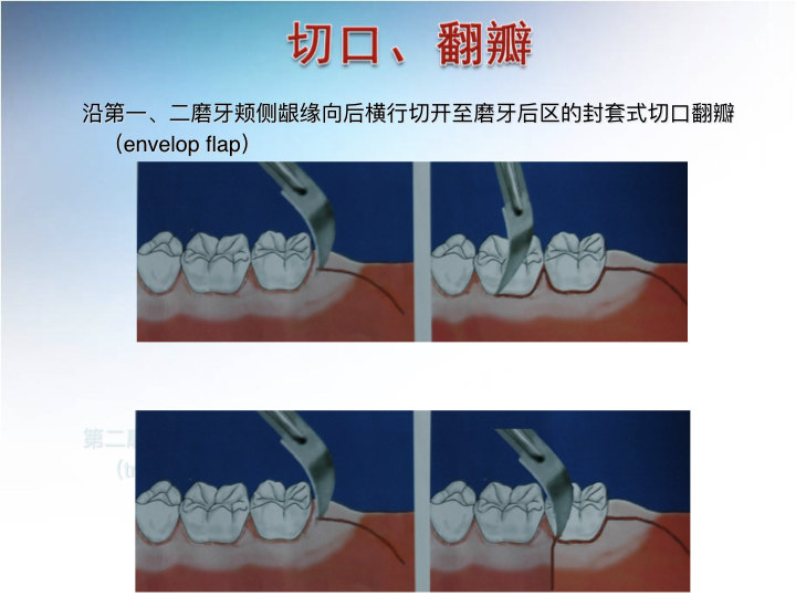 好大夫在线 常财旺 微创拔牙  无痛拔牙涉及患者的术前详细评估和设计