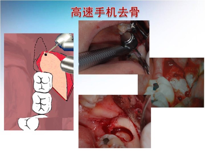 扬州大学附属医院 常财旺 文章列表 >微创拔牙   无痛拔牙涉及患者的