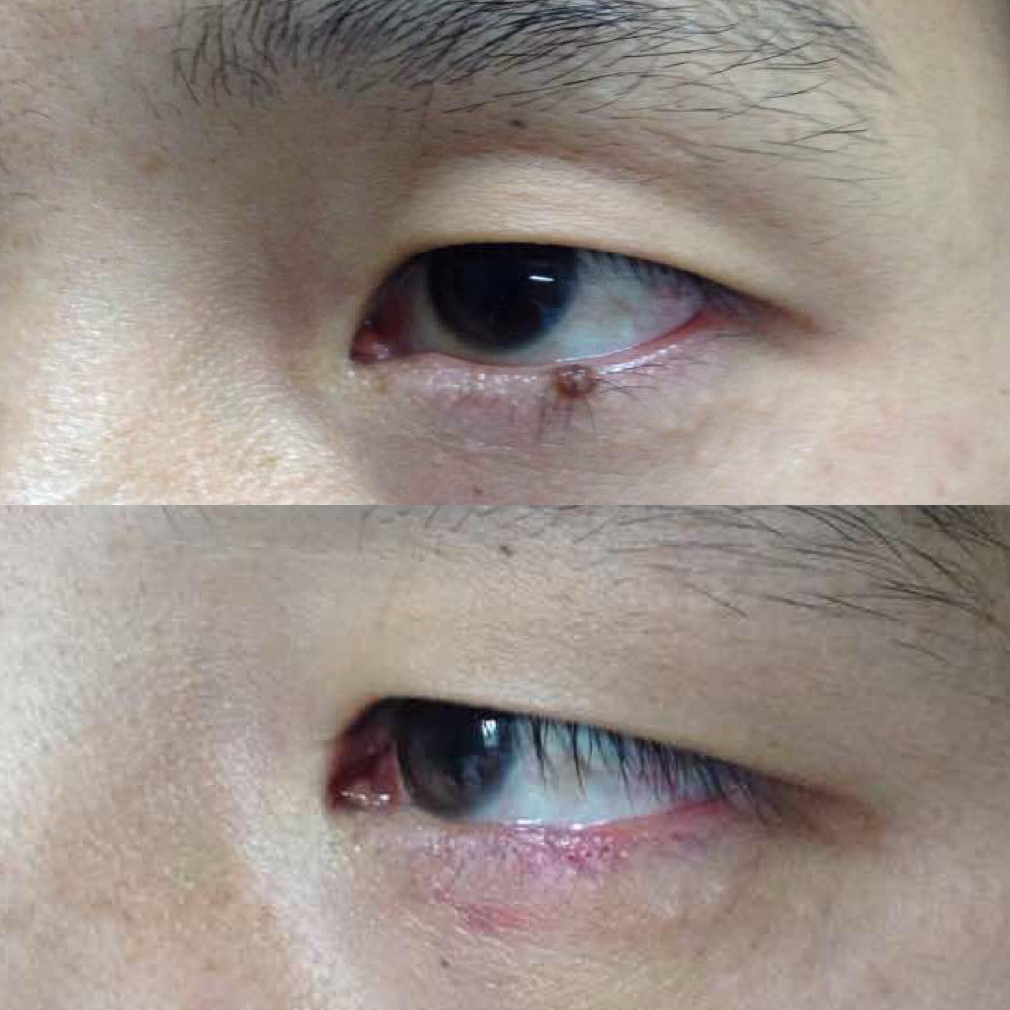 眼皮上的痣能切吗?