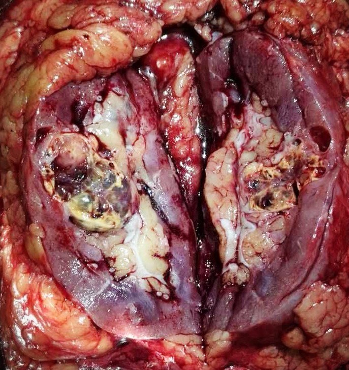腹腔镜肾切除\/部分切除术(肿瘤性、无功能肾、
