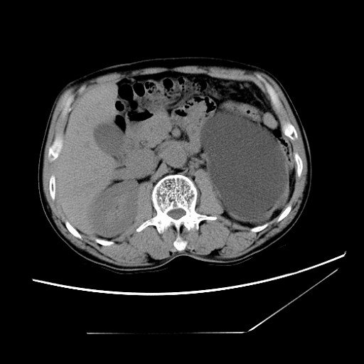 腹腔镜肾切除\/部分切除术(肿瘤性、无功能肾、