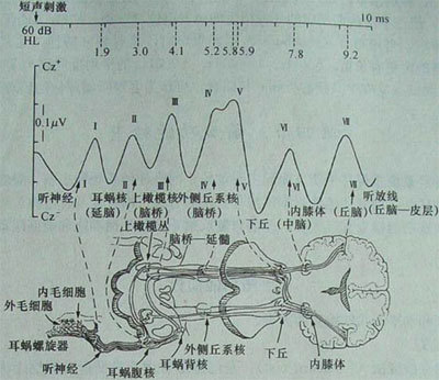 听觉脑干诱发电位(abr)是由声音刺激引起的神经冲动在脑干听觉传导