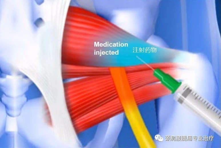 图解梨状肌综合征屁股深处的疼痛