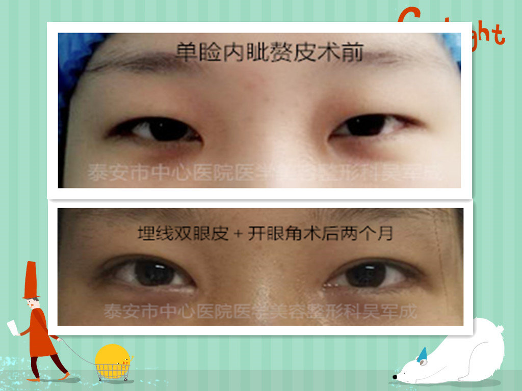 双眼皮开眼角重睑修复多图对比照片持续更新中