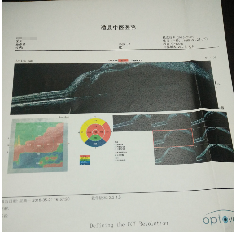 澧县中医医院成功开展多例孔源性视网膜脱离外路手术.