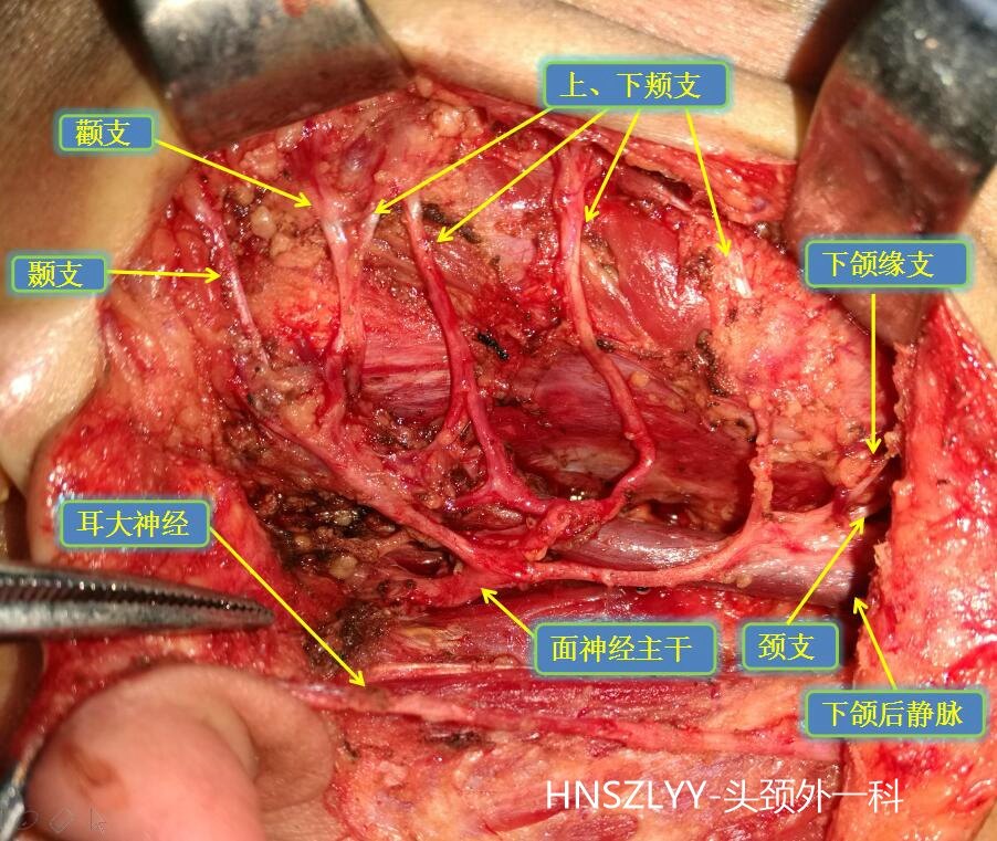 腮腺良性肿瘤的手术治疗(附图片)