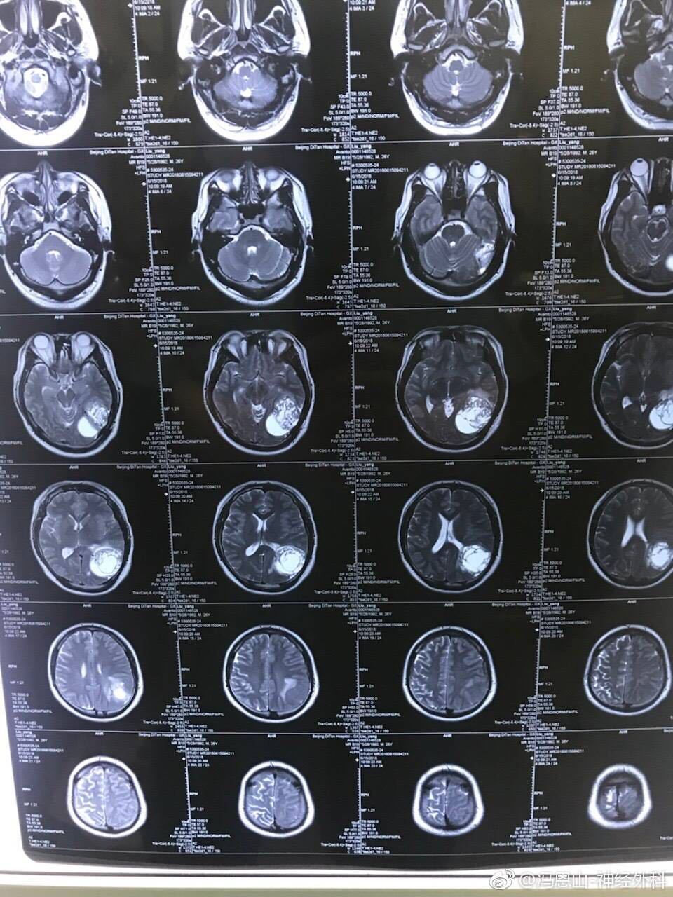 胶质瘤还是恶性脑膜瘤