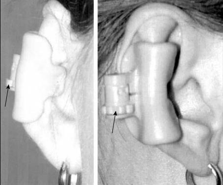 钳夹于外耳廓,成功治疗了各类耳形态畸形,尤其以隐耳治疗效果为佳