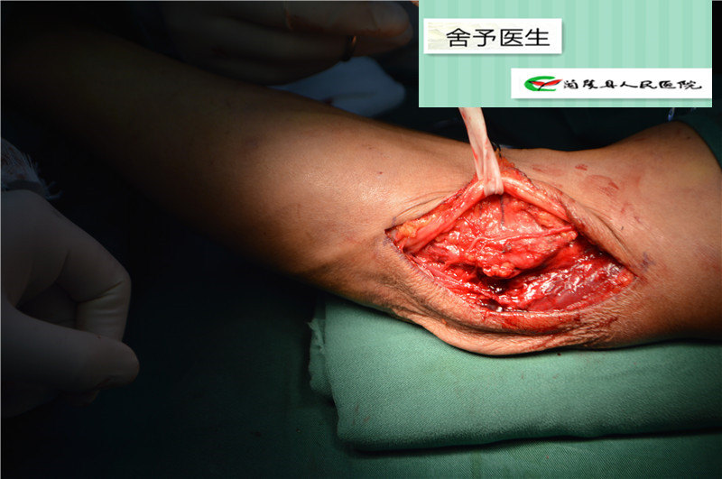 大夫在线 舒景坤 ></p></a> 肘管综合症——大切口还是小切口 尺神经前置手术