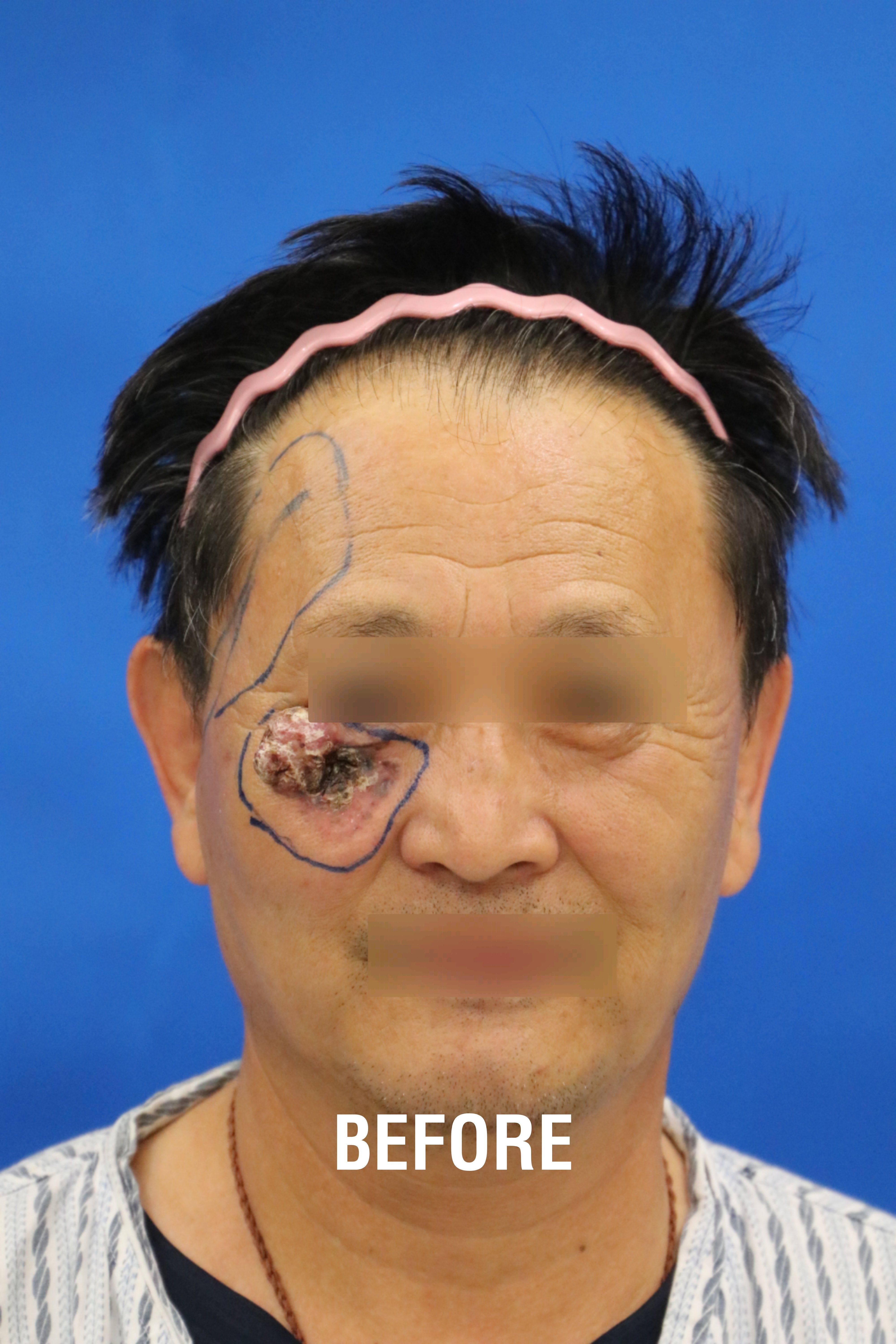 眼睑下方基底细胞癌案例