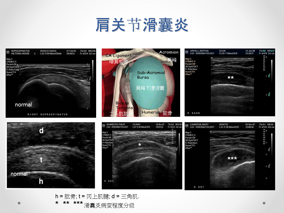 肌骨关节超声帮你找出潜伏亚临床滑膜炎