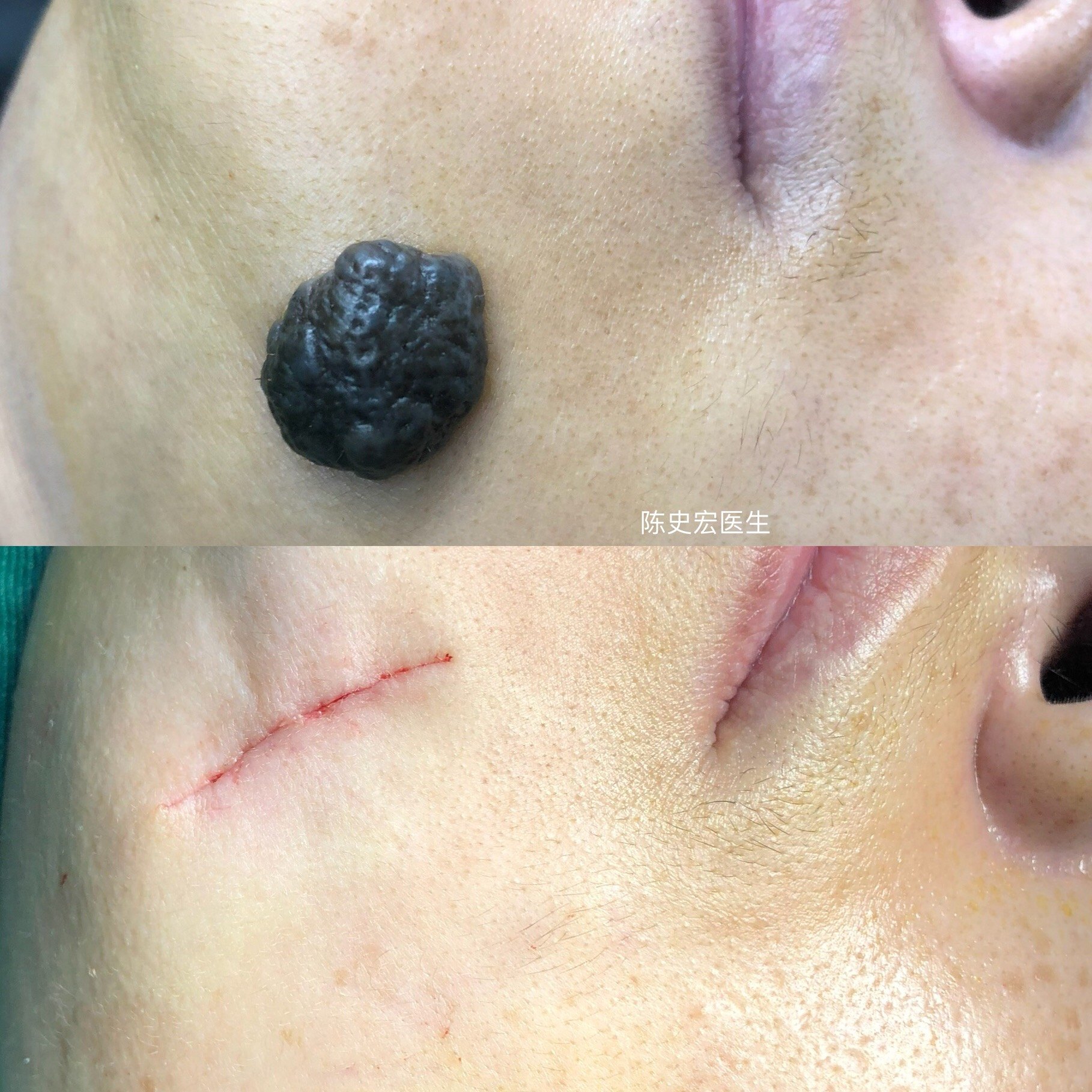 色素痣切除 精细缝合