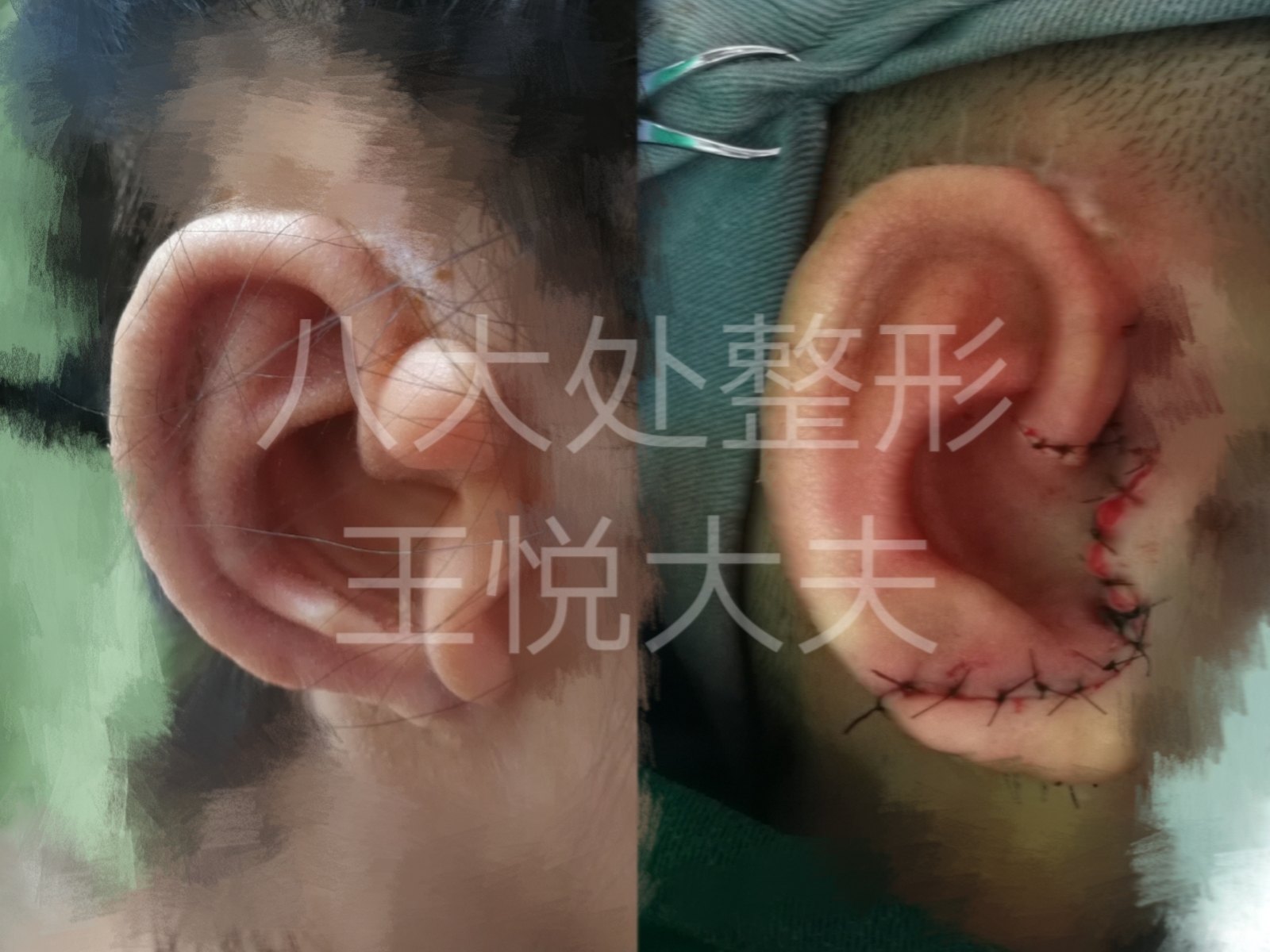 能做一个浅耳道么?_小耳畸形_小耳