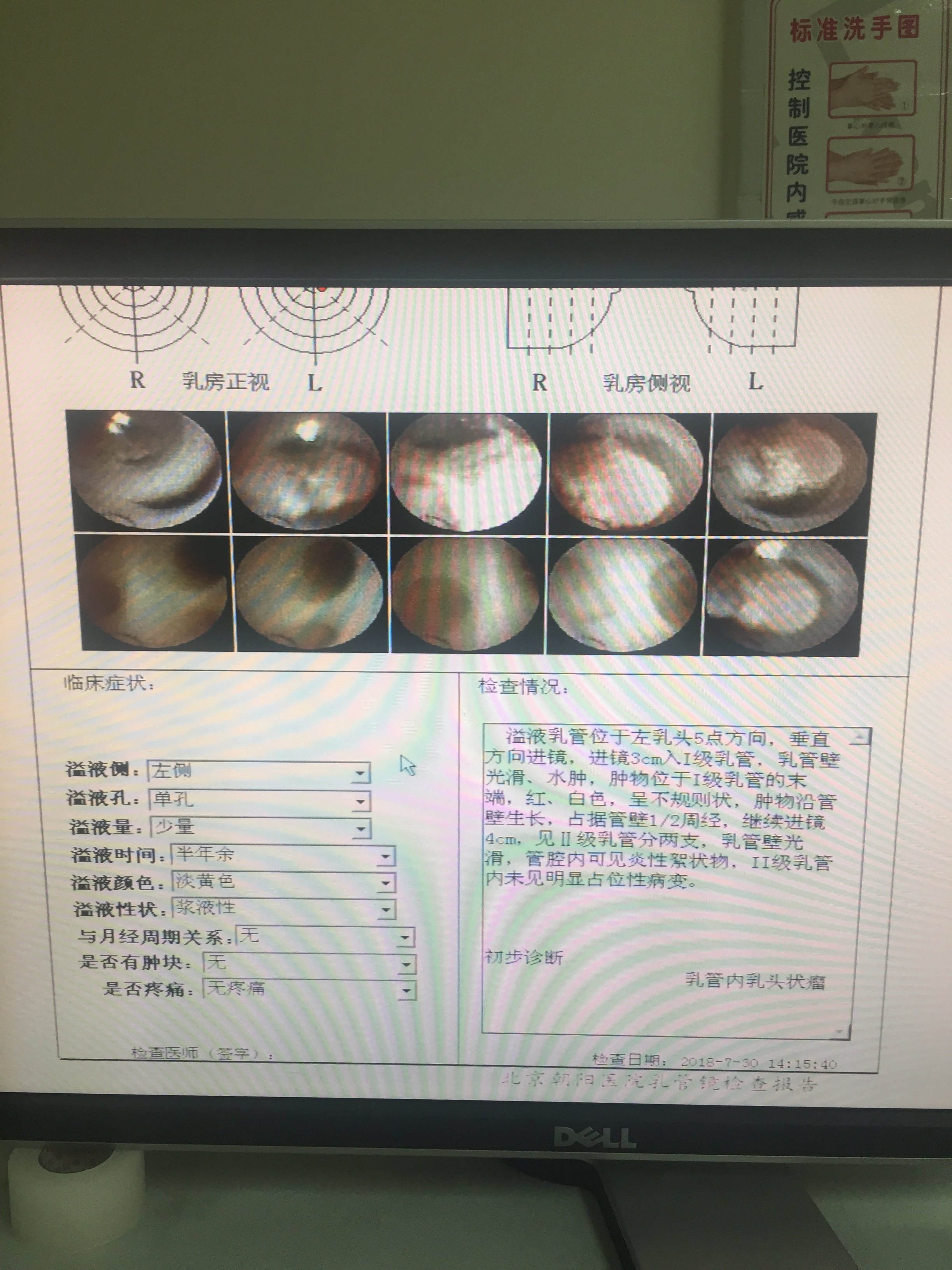 我院乳管镜设备