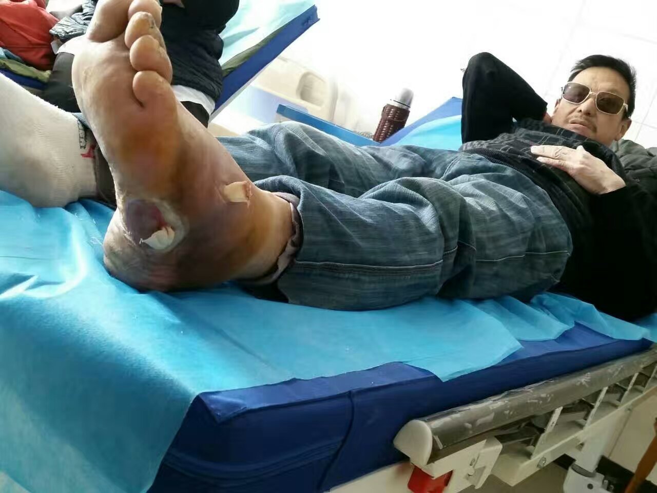 原创 糖尿病足,腿疼发麻眼睛看东西模糊看不清怎么治疗