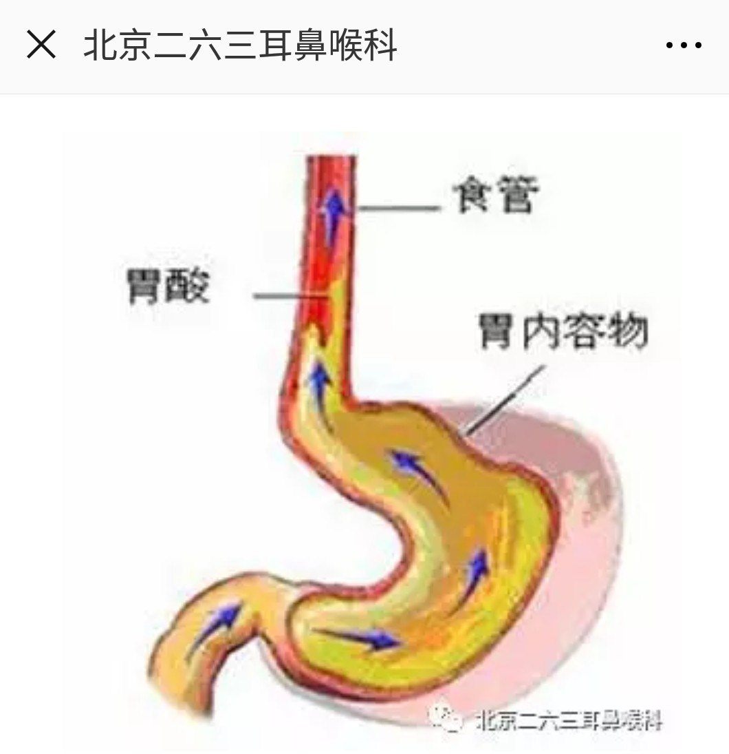 小心咽喉反流性疾病!