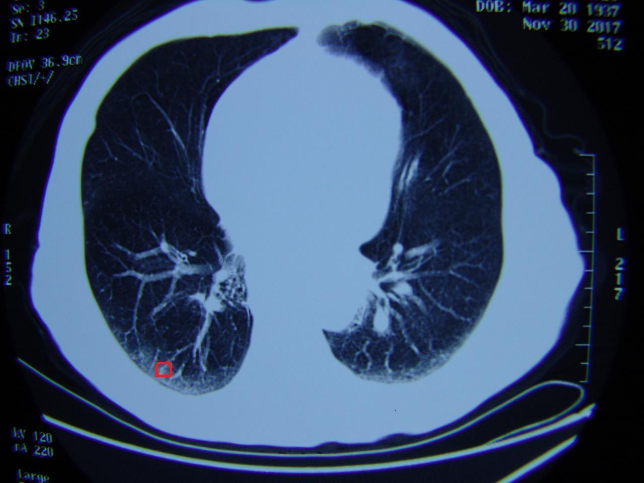 如果高度怀疑是肺癌,最好做一个胸片或者胸部ct,由于胸片分辨率低