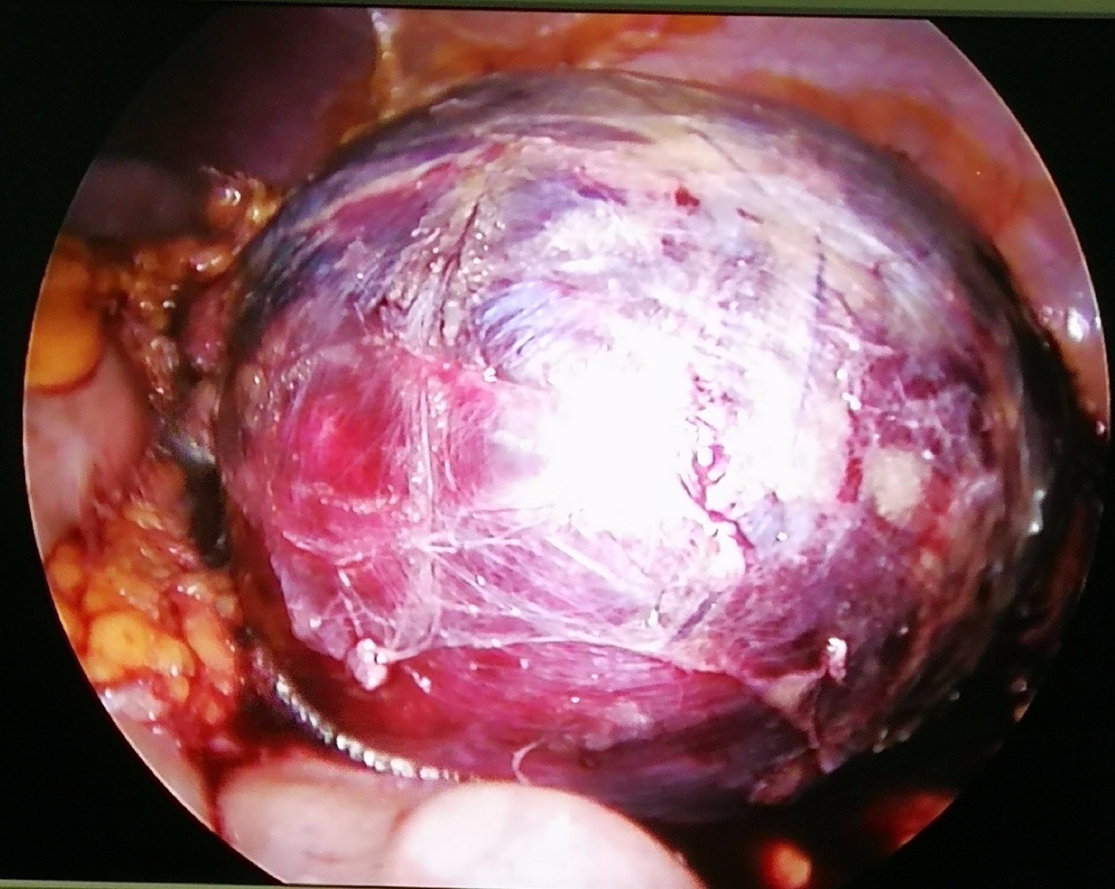 腹腔镜肾切除\/部分切除术(肿瘤性、无功能肾、