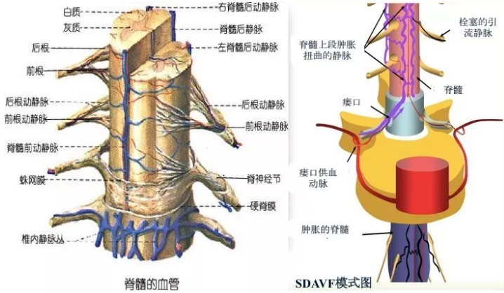 硬脊膜动静脉瘘你可能漏诊的脊髓损害