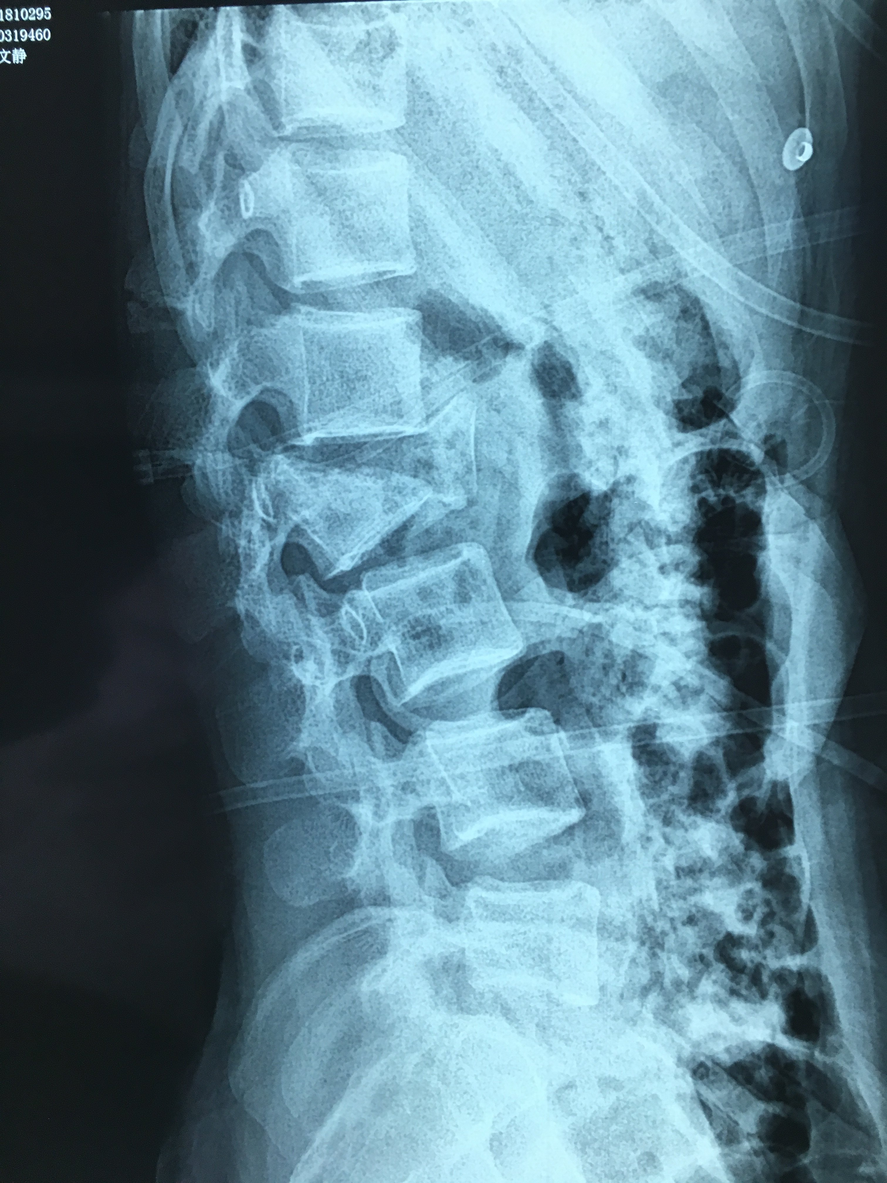 腰1椎体爆裂骨折