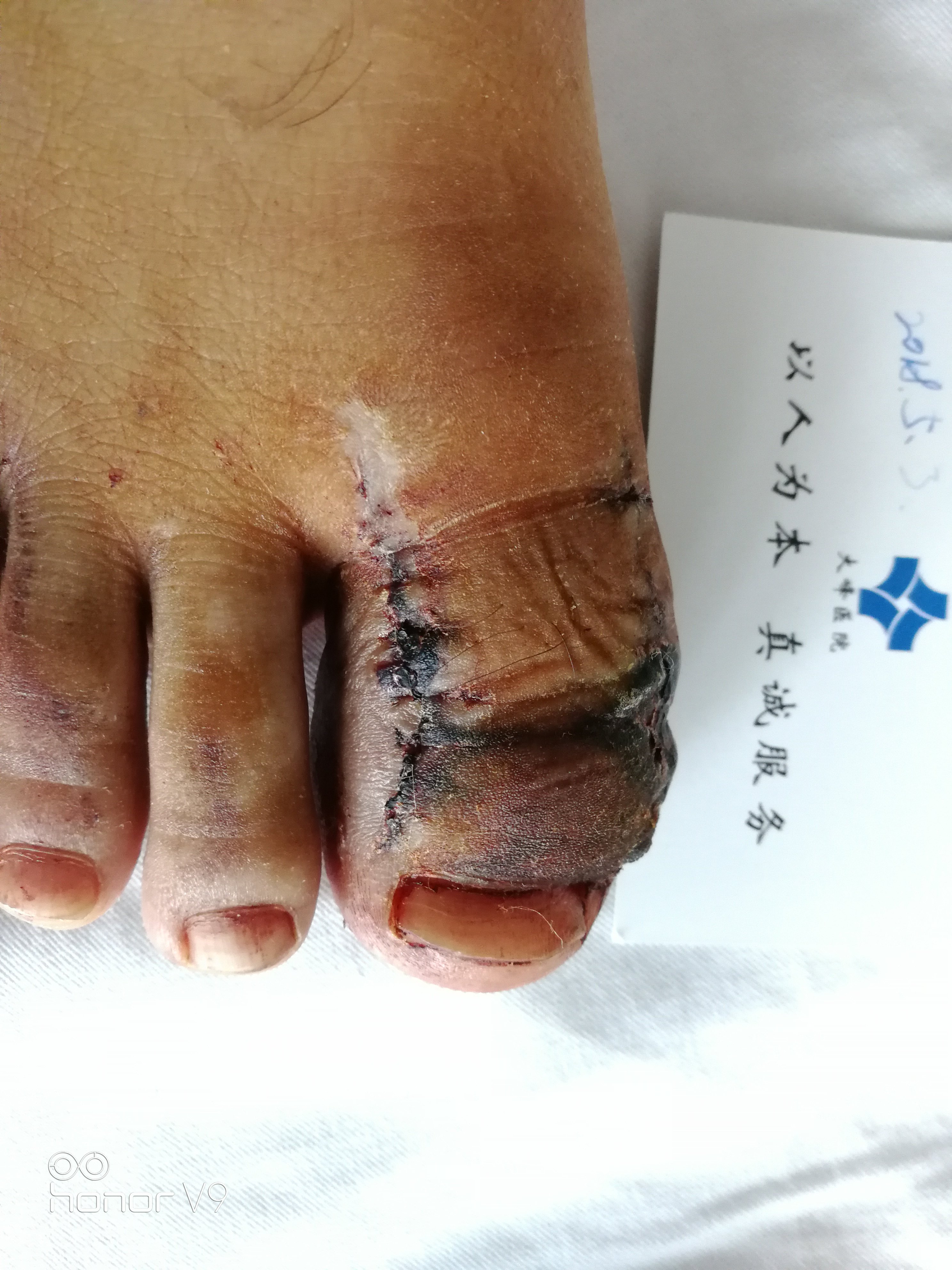 痛风结石要尽早切除而且能切好