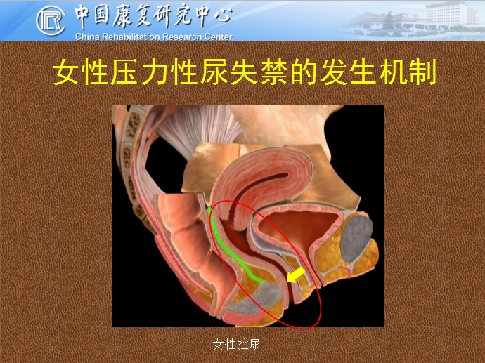 好大夫在线 张帆 > 女性压力性尿失禁的治疗 女性吊带作为治疗压力性