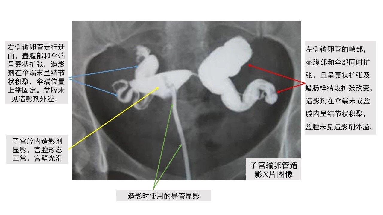 输卵管积水用哪些方法可以诊断