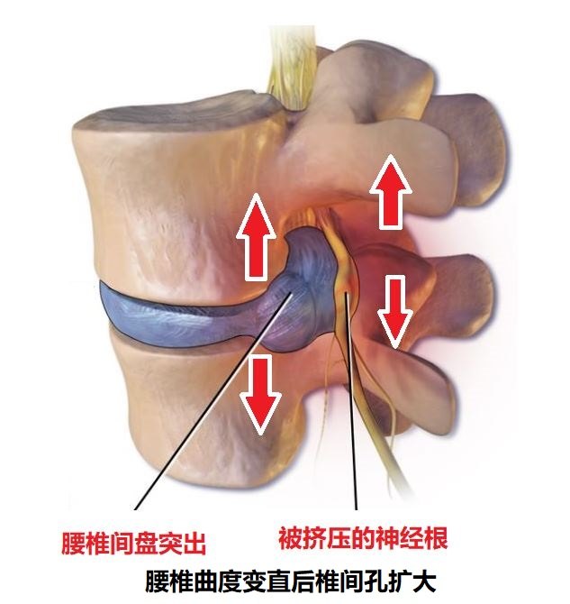 变直时,腰椎间盘后方的压力会减小一些(见下图,腰椎小关节会轻微张开