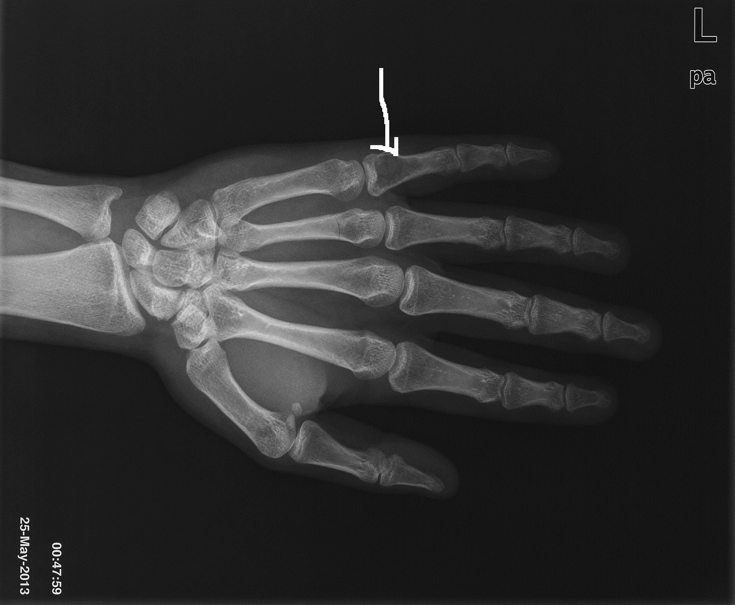 理学療法士 PhysiTheraResearch: 手の骨 Bones of hand：理学療法士による身体活動研究