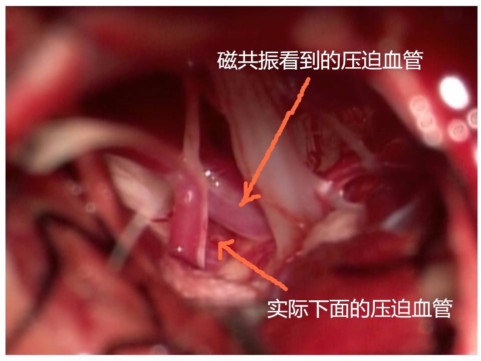 术中发现这个血管下面还有一根压迫血管,直接压在面神经根部,小脑充分