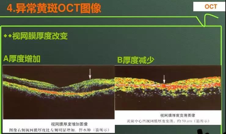 清晰的显示眼后段主要是黄斑和视乳头的形态特征,视网膜的层间结构