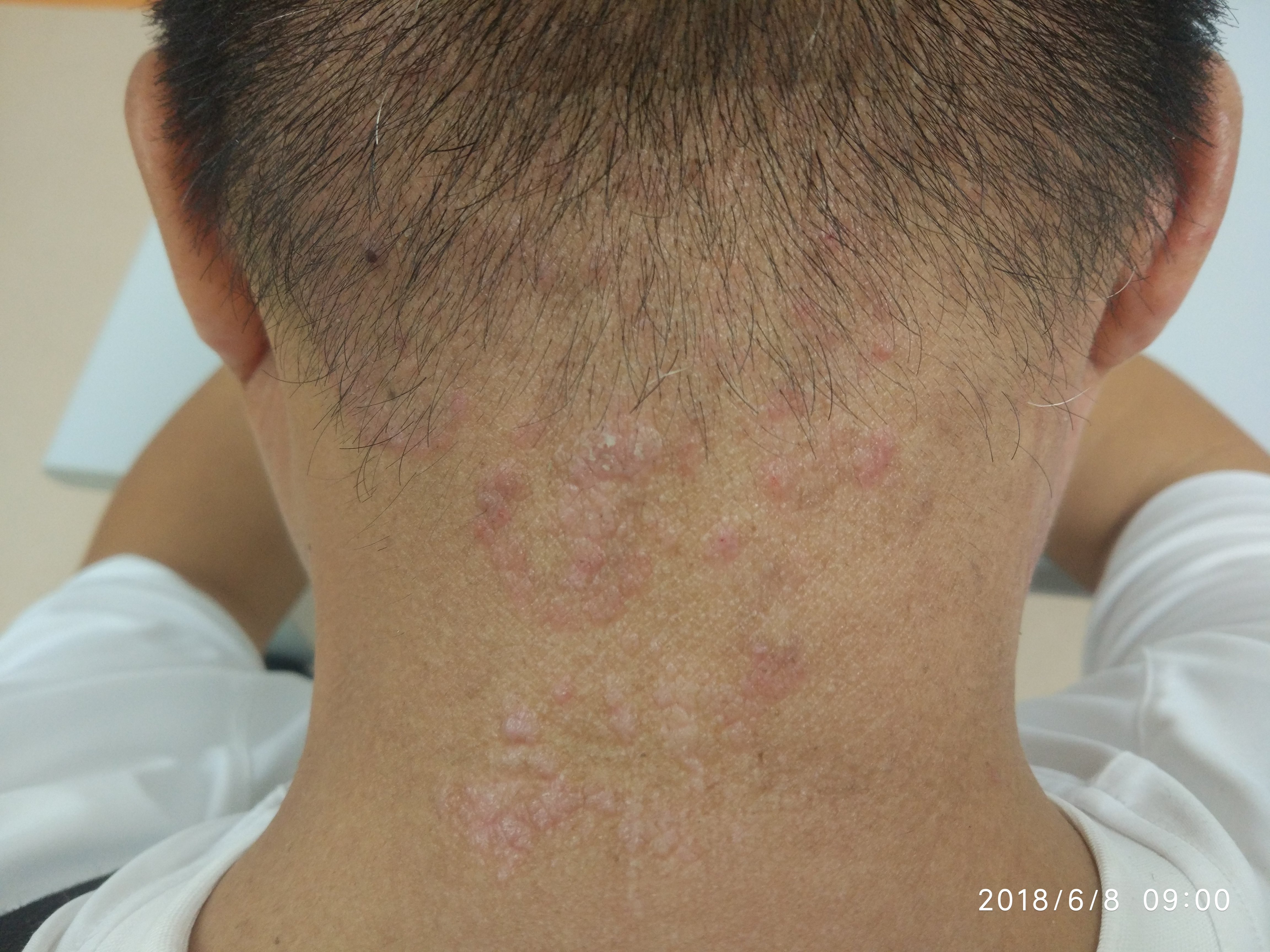 被误诊3年的皮肤病