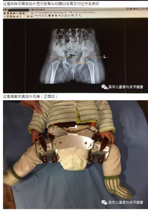 髋关节脱位手法复位石膏固定术后护理与案例展示