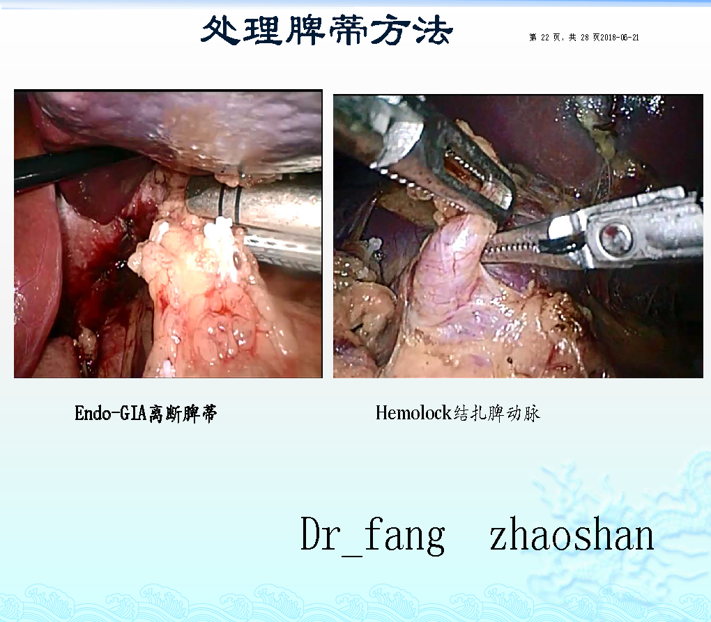 脾脏解剖及脾脏生理功能 3. 腹腔镜 脾切除术 适应症 4.