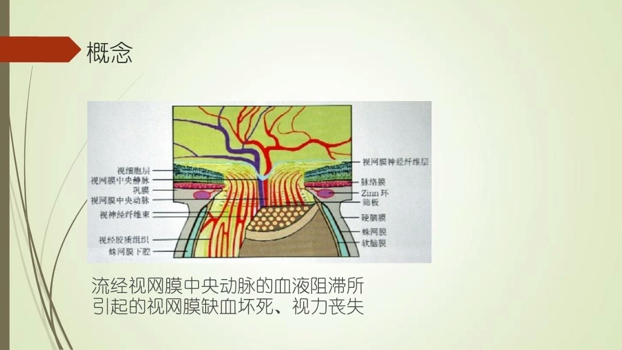 视网膜中央动脉阻塞内附ppt图26张