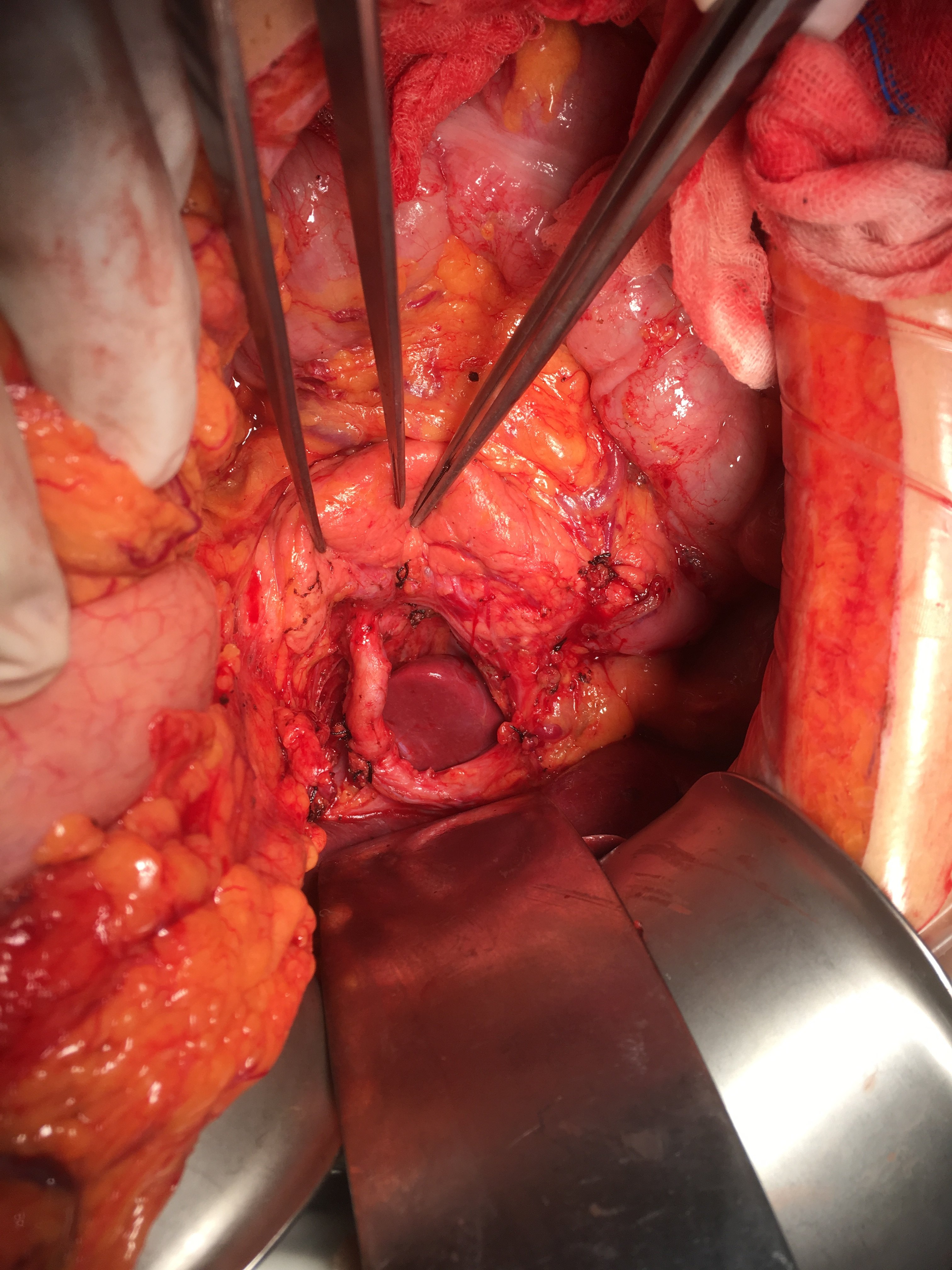 胃癌根治术中见变异的肝总动脉走行于肝胃韧带内
