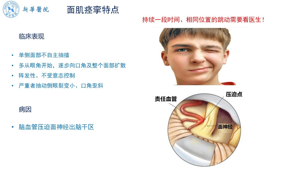 五张图看懂面肌痉挛