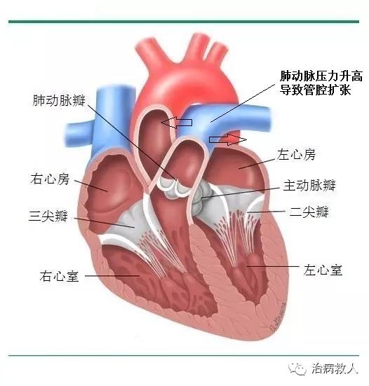 当肺动脉高压形成时,迫使心脏泵血更费力,致使人们出现呼吸困难和易