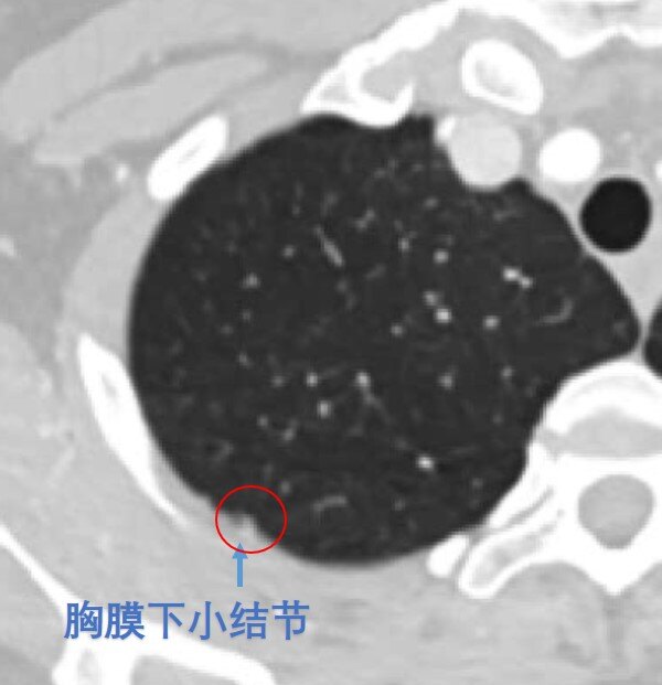 (1)胸膜下微小结节:可参考韩医生之前科普《胸膜下小结节是什么,良性