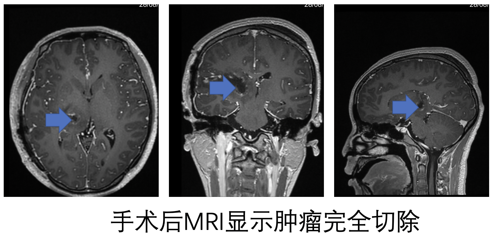 丘脑胶质瘤怎么治疗