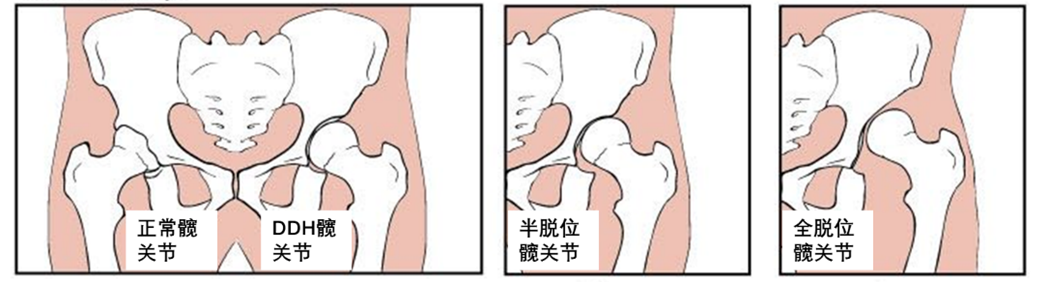 先天性髋关节脱位