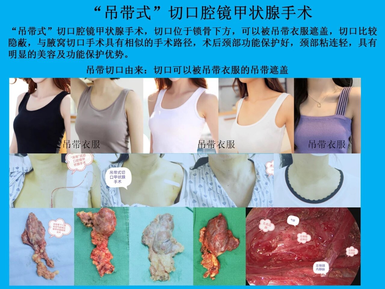 颈部无瘢痕甲状腺手术技术