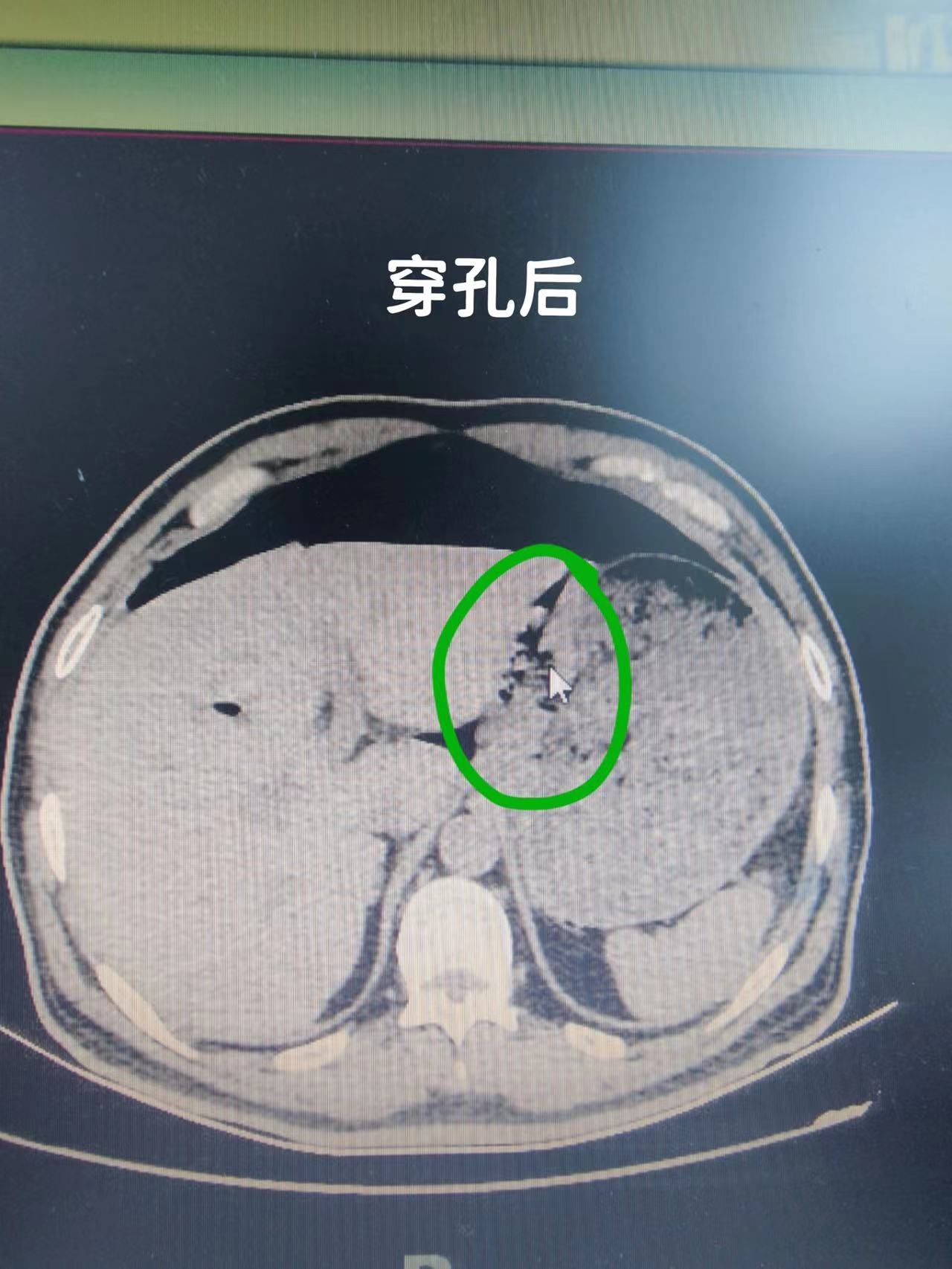 一例胃穿孔患者紧急救治的案例分享