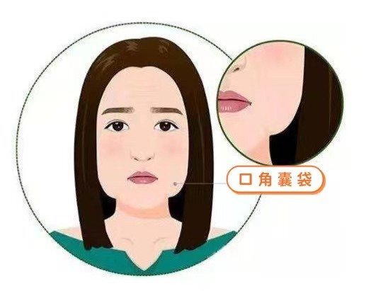 木偶纹呢就是法令纹向外侧口角向下延续到下颌的这一段的纹路,主要是