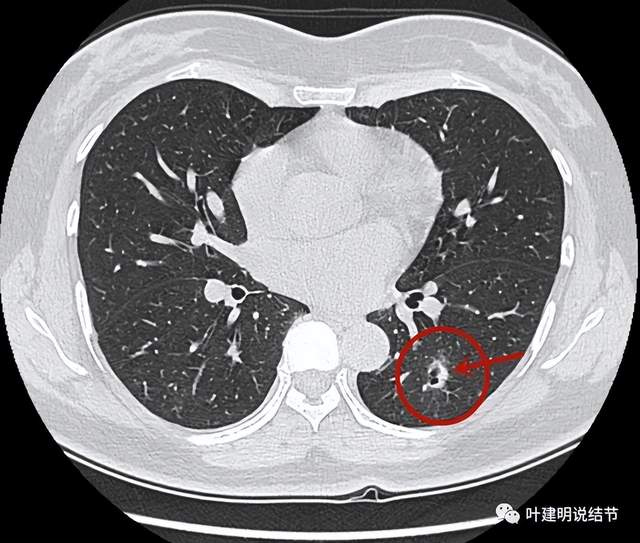 疑难也是两难的肺多发结节病例我们该如何来进行临床决策分析从而对